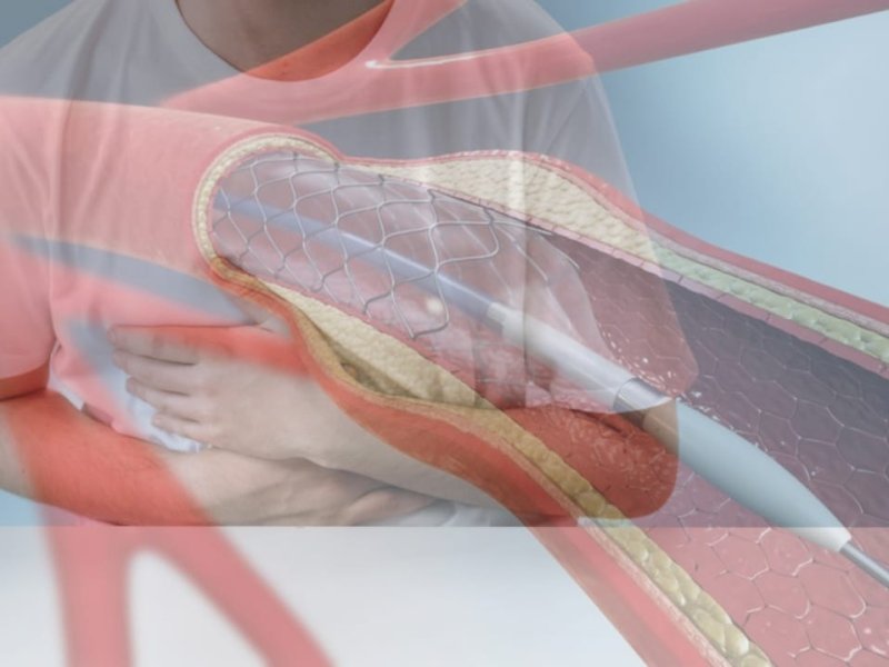 Ilustrasi sakit jantung dan ring di jantung. (Pexles/Cottonbro/Heartfoundation.org.au)