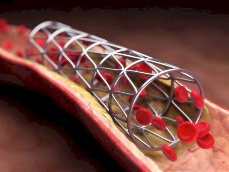 Ilustrasi. Keteter. (Google).