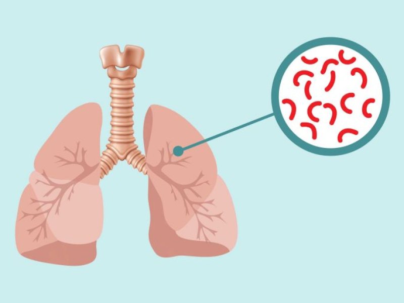 Ilustrasi Tuberkulosis (Dok. RS Panti Rapih)