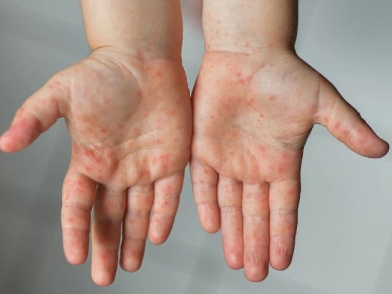 Kemenkes Laporkan KLB Campak Di 31 Provinsi. @Jejakfakta/Ilustrasi