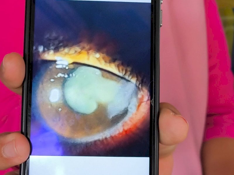 MAY (13), mengalami luka serius pada mata kanannya akibat insiden candaan berbahaya dari temannya dengan melemparkan tusuk bakso. @Jejakfakta/Istimewa