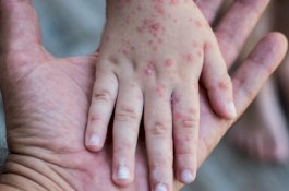 IDAI Peringatkan Ancaman KLB Campak, Serukan Kejar Imunisasi Anak di Indonesia